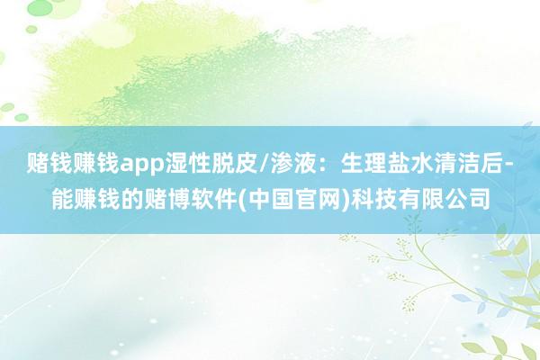赌钱赚钱app湿性脱皮/渗液：生理盐水清洁后-能赚钱的赌博软件(中国官网)科技有限公司